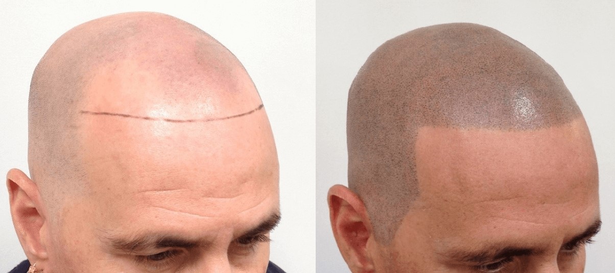 The Best Hair Loss Treatment Is Scalp Micropigmentation